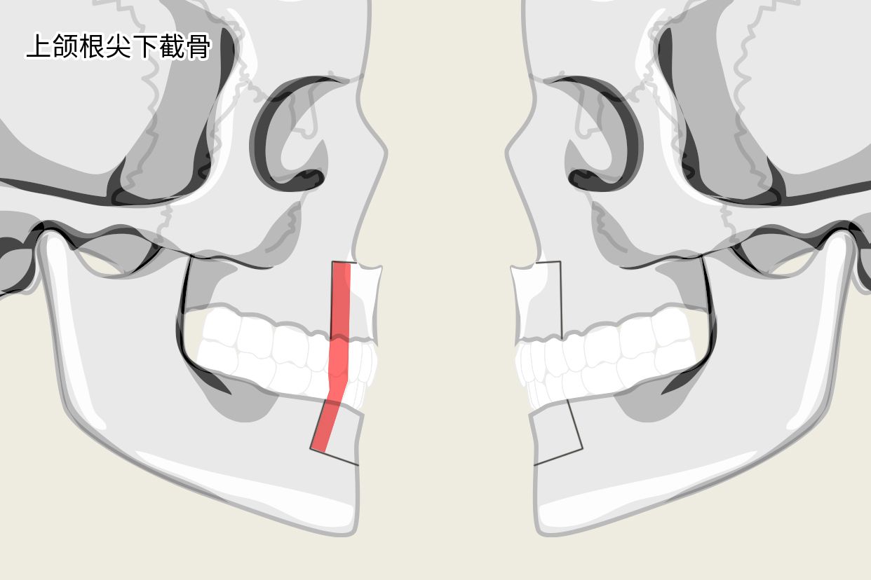 上颌根尖下截骨示意图