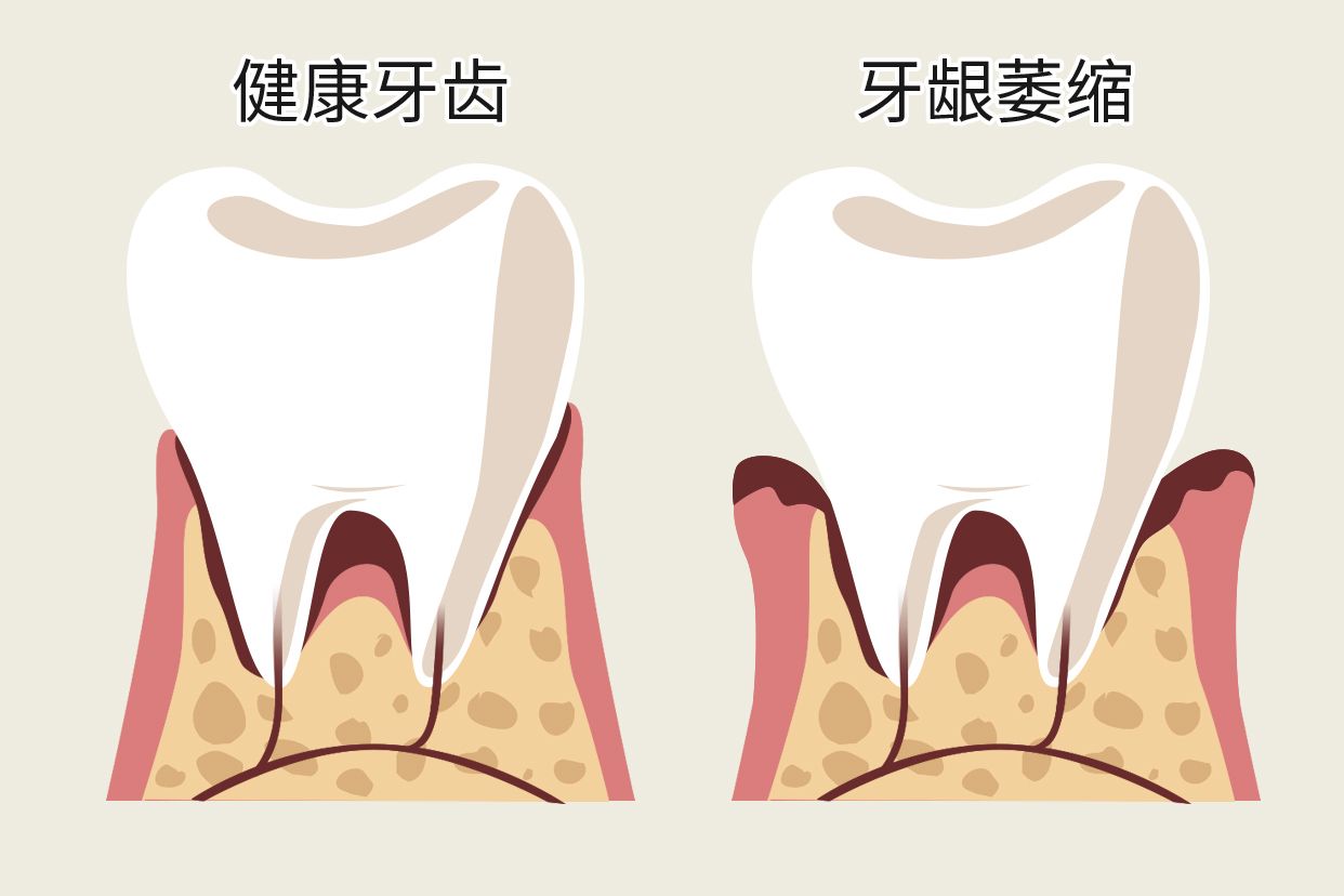 单个牙龈萎缩图片