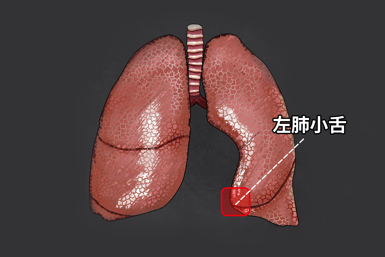 左肺小舌图片