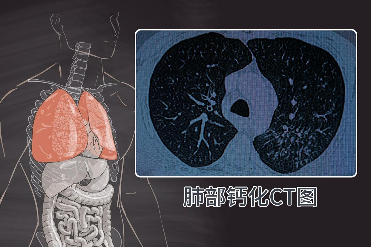 肺部钙化ct图像啥样的