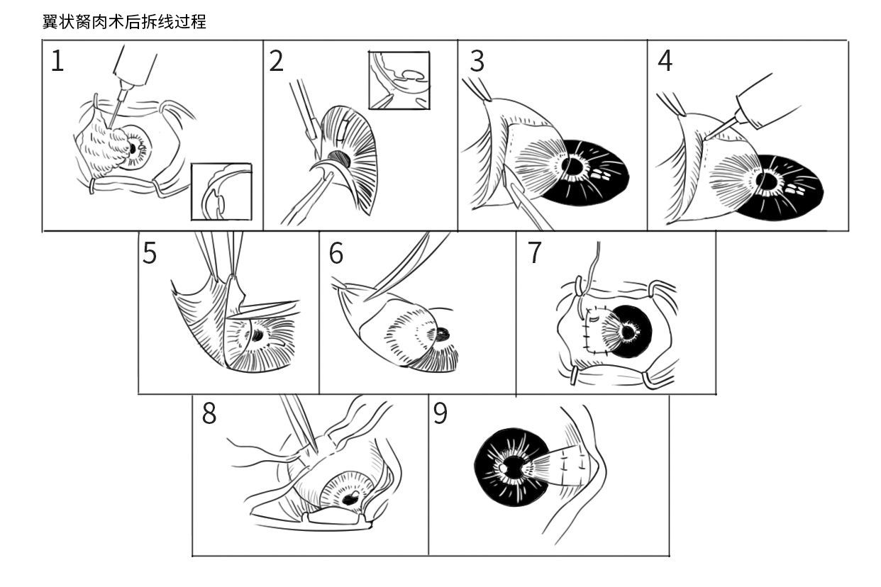 翼状胬肉术后拆线过程图 翼状胬肉手术缝线几天拆线