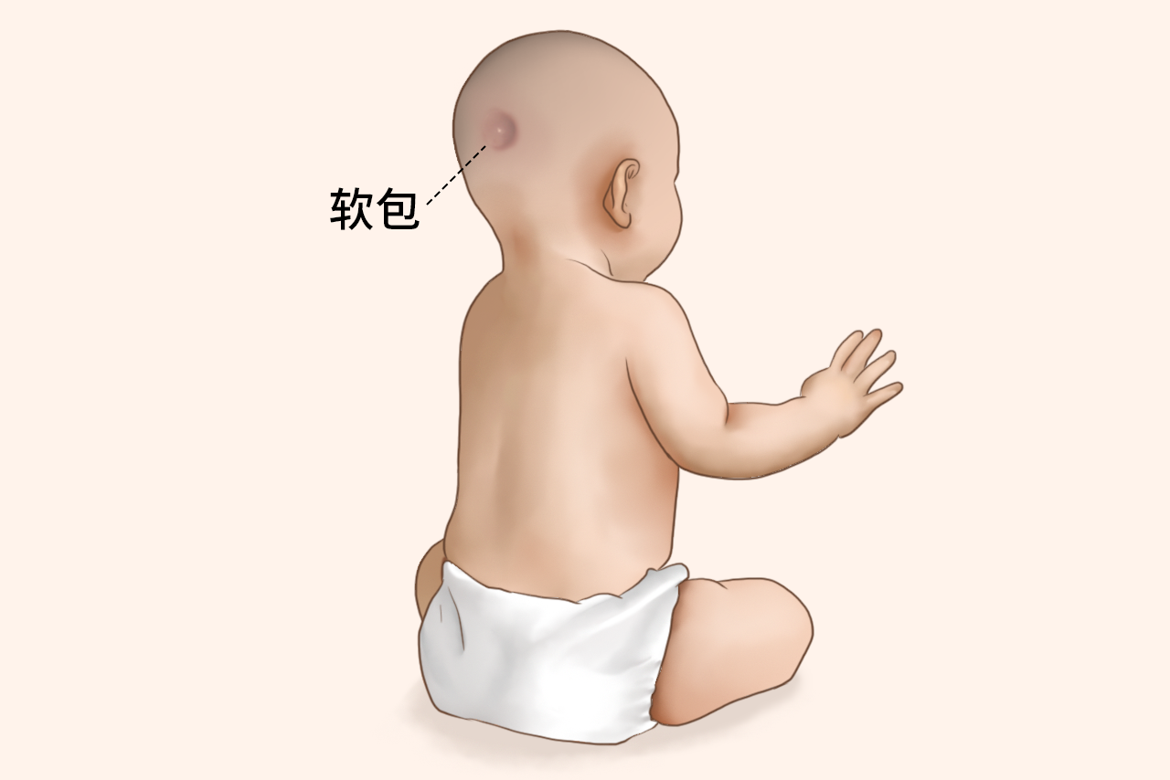 6个月婴儿后脑有个软包图片（六个月宝宝后脑勺有个包凸起软软的）