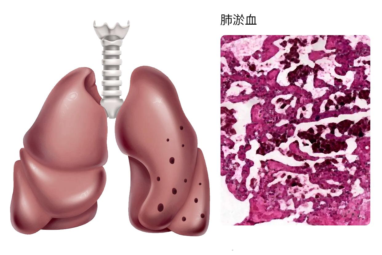 肺淤血图片（肺淤血图片红蓝铅笔）