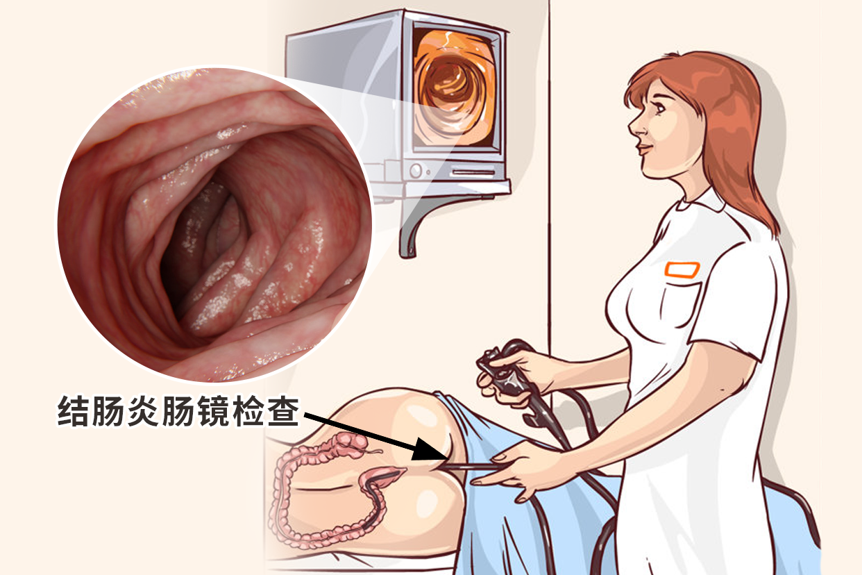 结肠炎肠镜检查图片（结肠炎肠镜检查显示什么）