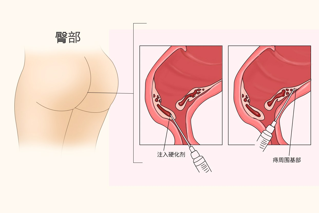 痔疮打针后一个星期后图片 痔疮打针后几天能烂完不痛了