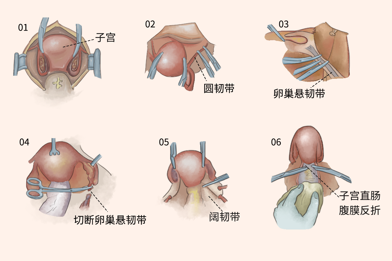 子宫卵巢的切除手术示意图 子宫卵巢的切除手术示意图图片