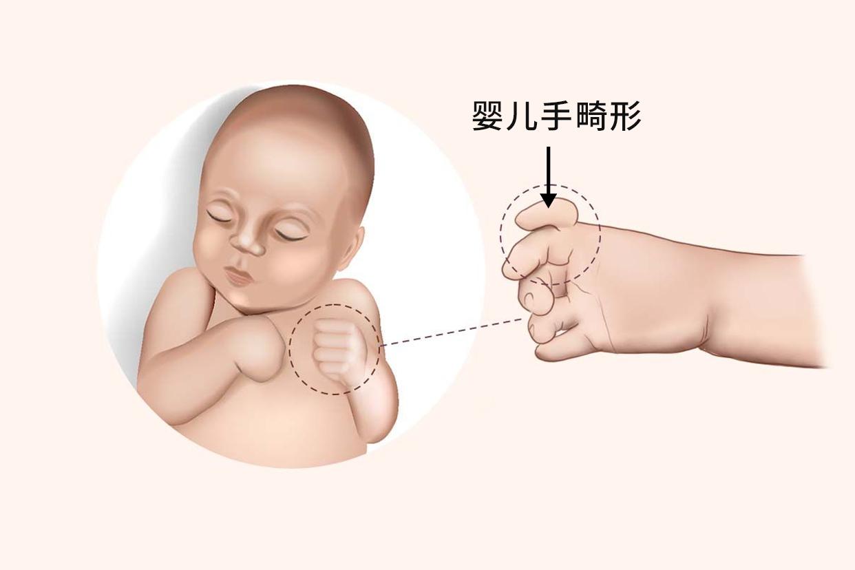 婴儿手畸形图片 婴儿手指畸形图片