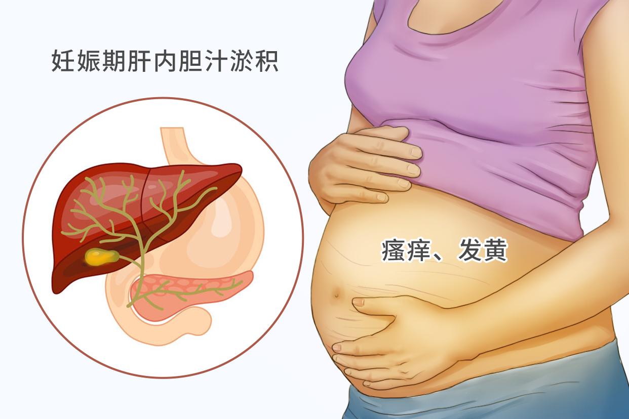 孕妇胆淤和湿疹的图片（孕妇胆淤和湿疹的图片区别）