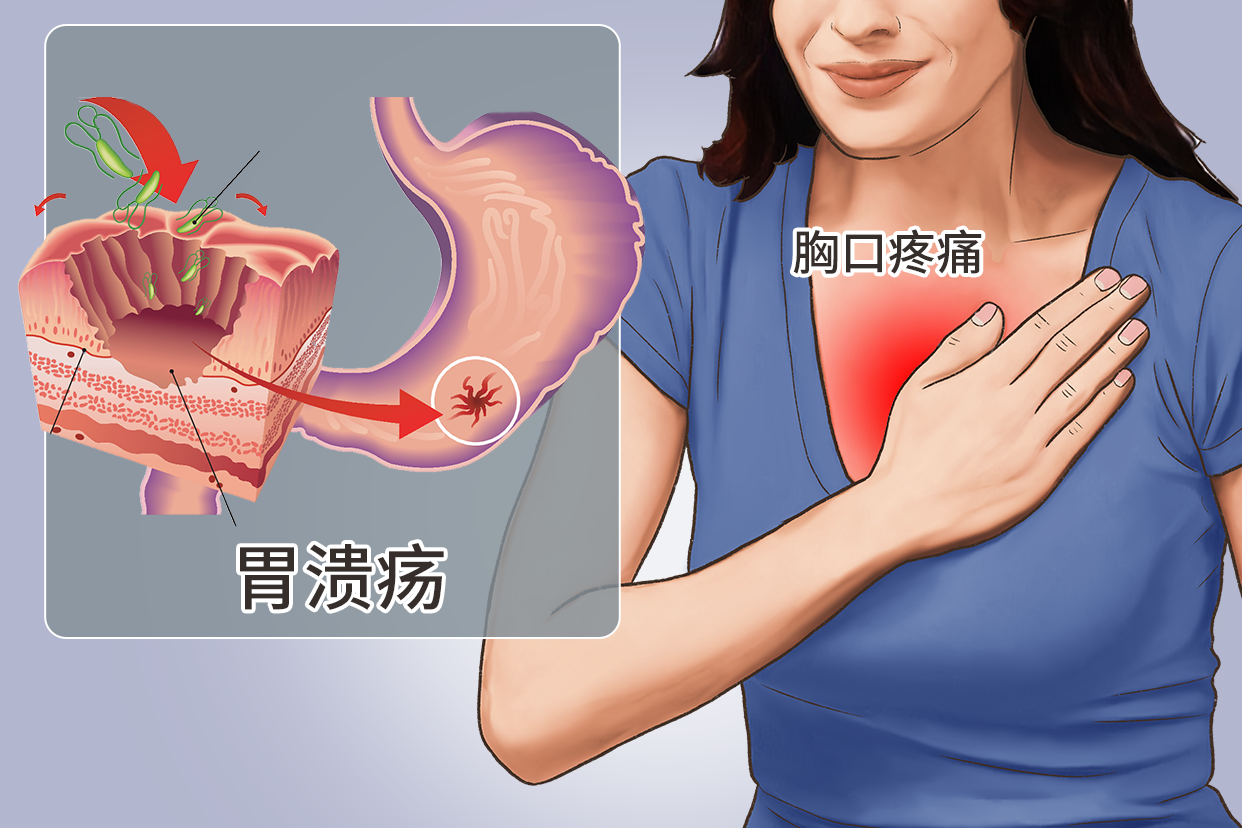胃溃疡胸口疼位置图（胃溃疡胸腔疼）