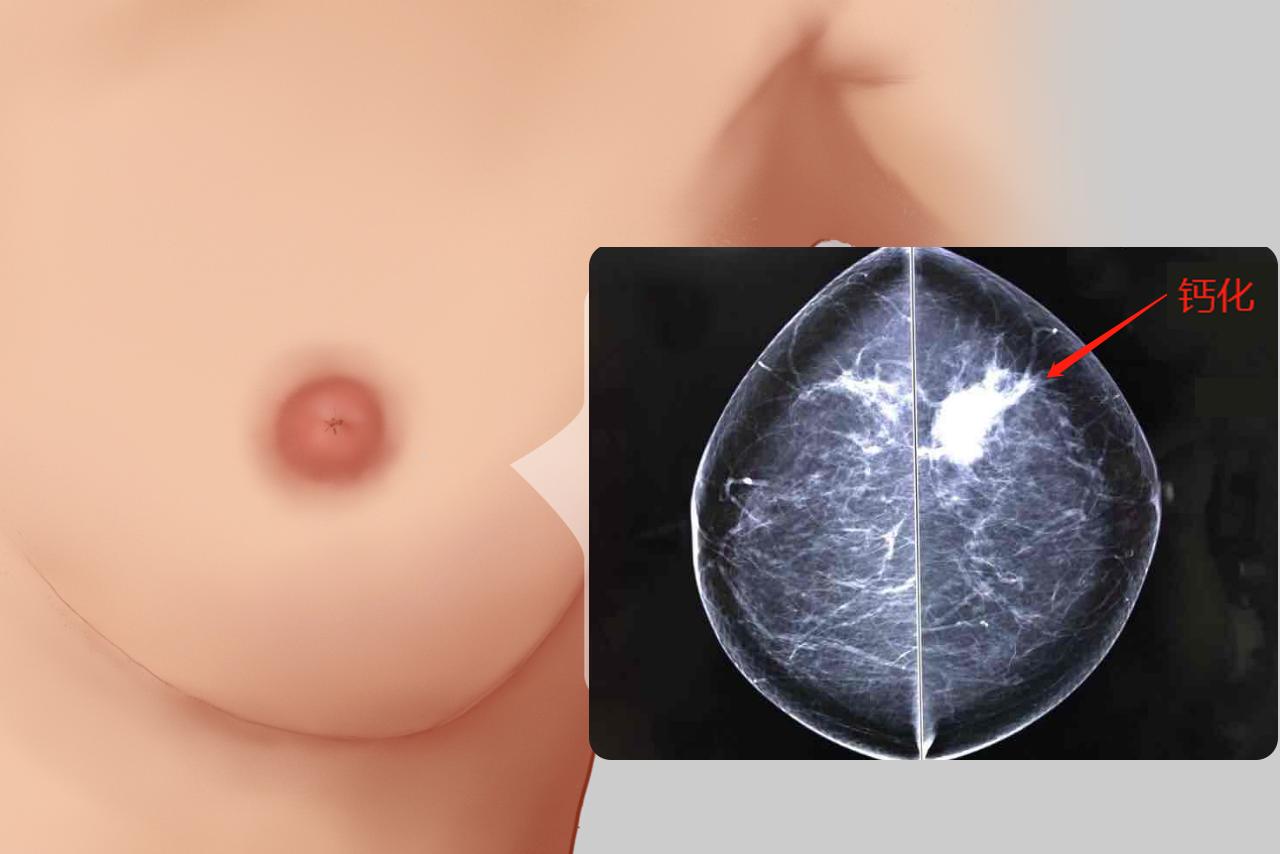 乳腺癌钙化图片（乳腺癌钙化特点）