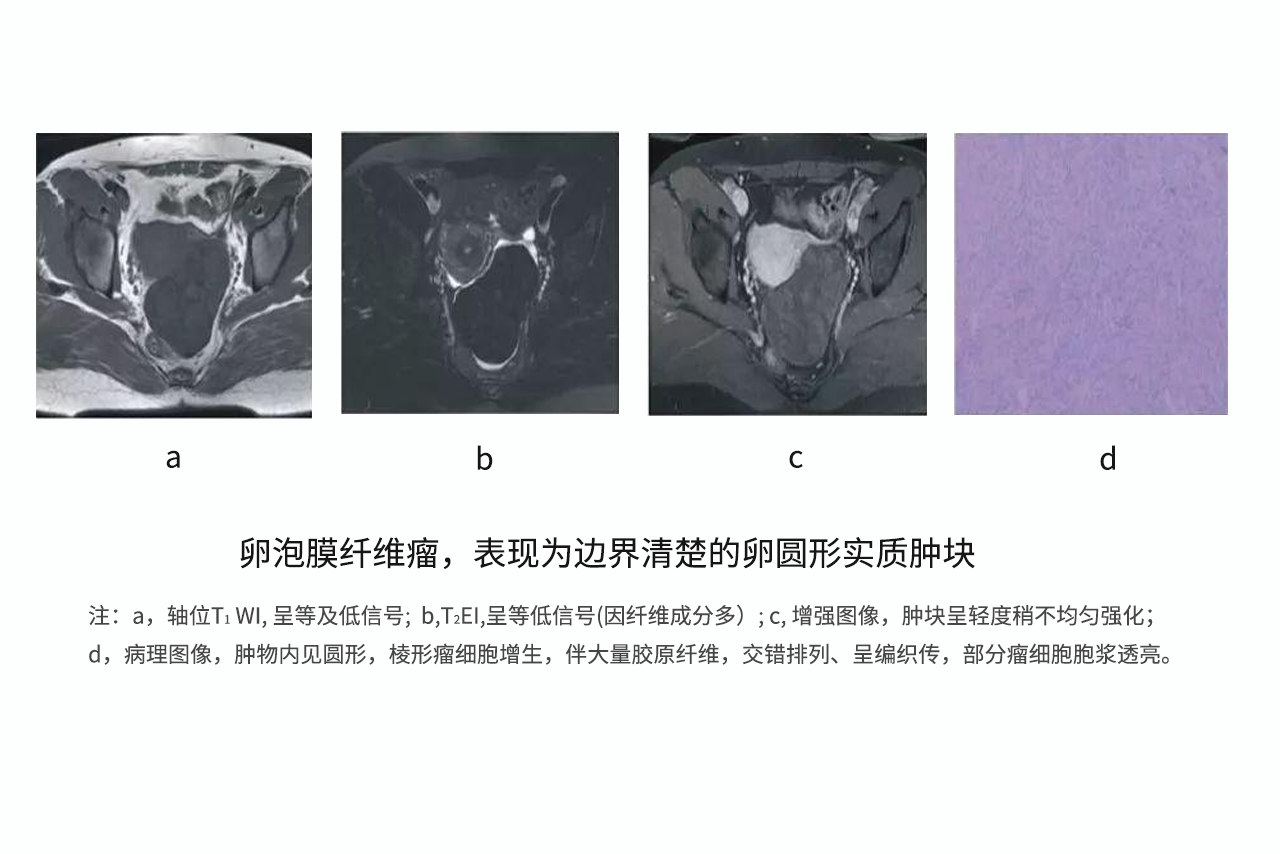 纤维卵泡膜细胞瘤图片 纤维卵泡膜细胞瘤症状