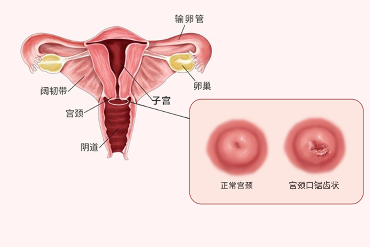 宫颈口锯齿状图片