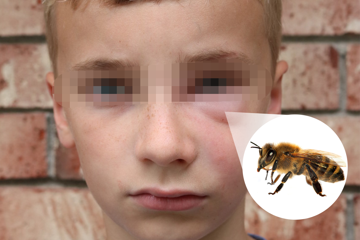 小孩被蜜蜂蛰了肿图片