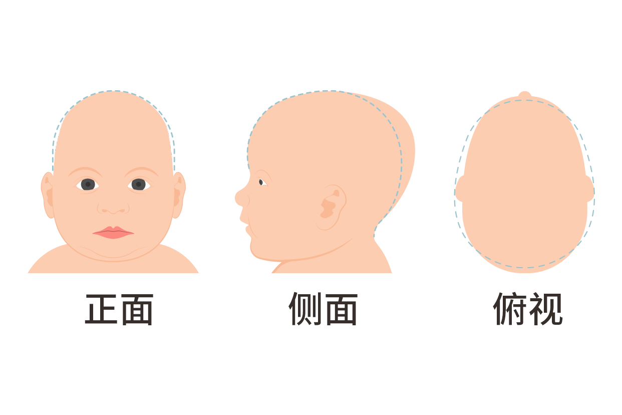 婴儿头两侧有凹陷怎么回事图片
