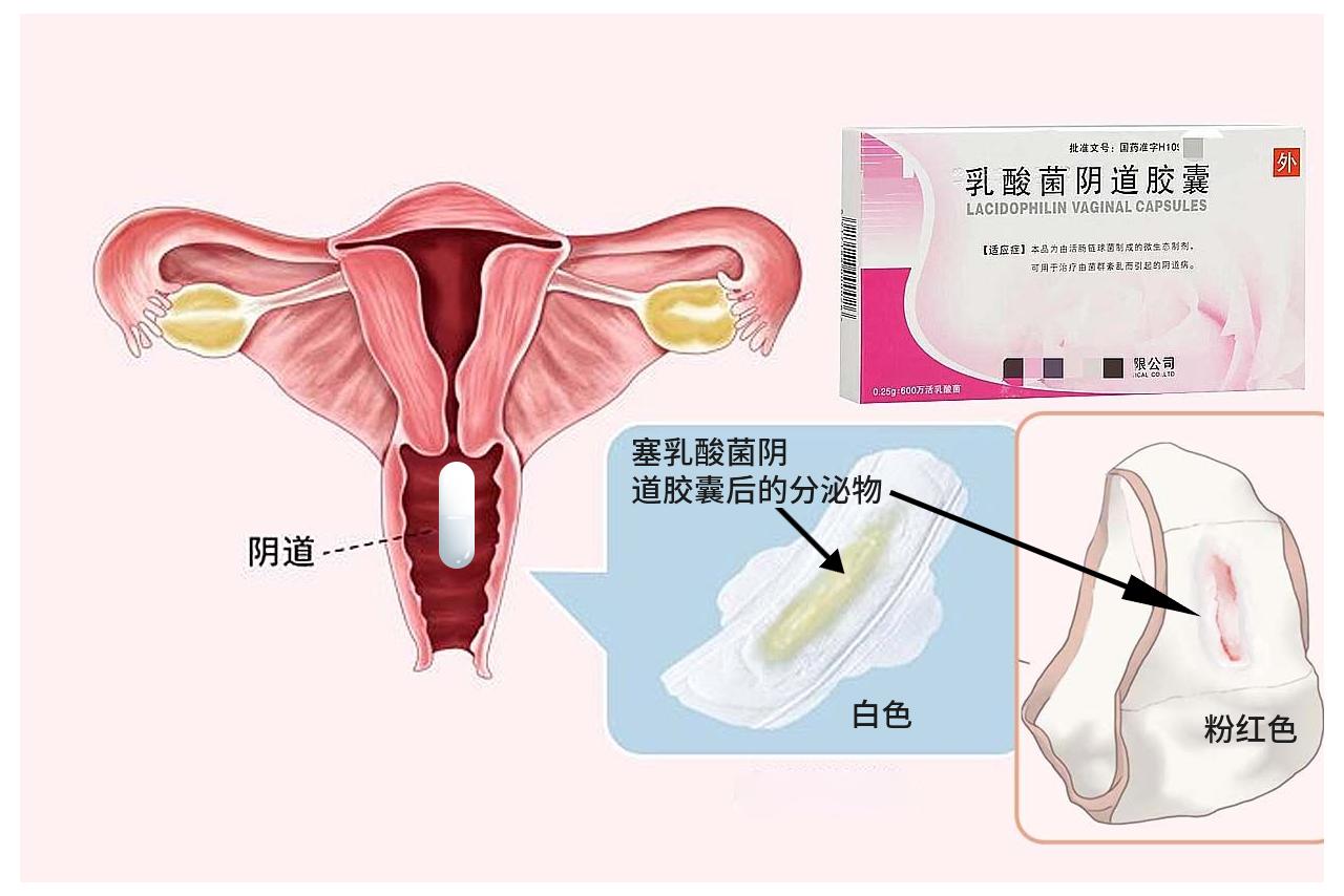 塞乳酸菌后的分泌物图片